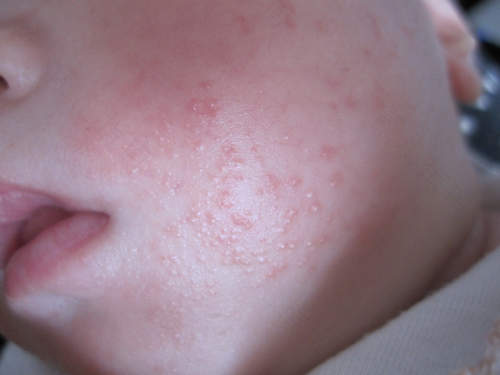 大人的湿疹和小孩的湿疹一样吗