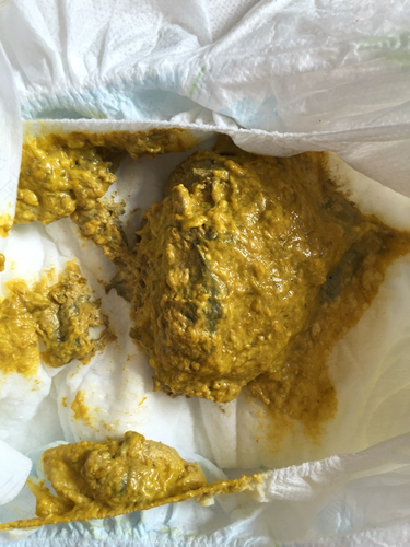 老是要大便是怎么回事 老是要大便是怎么回事