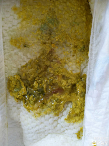 总是爱解大便是怎么回事 总是爱解大便是怎么回事