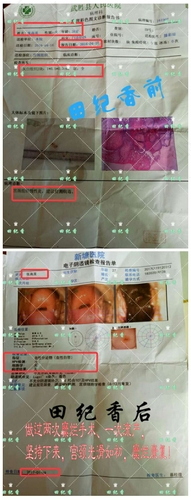 宫颈纳囊是宫颈病变吗? 宫颈纳囊是宫颈病变吗?