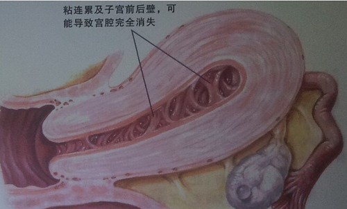 子宫颈粘连怎么治疗 子宫颈粘连怎么治疗