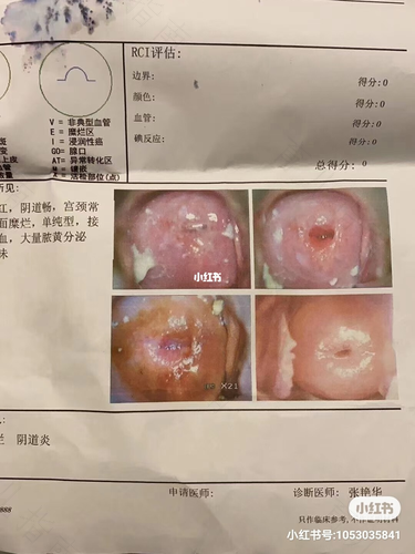 宫颈糜烂中度需要修复吗 宫颈糜烂中度需要修复吗