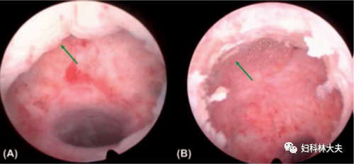 子宫憩室怎么治疗最好 子宫憩室怎么治疗最好