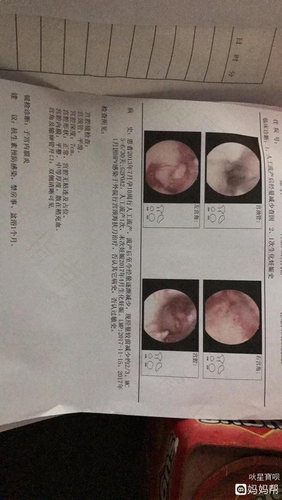 子宫内膜炎症会影响怀孕吗 子宫内膜炎症会影响怀孕吗