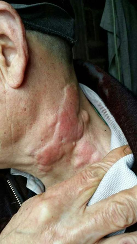 上火会导致淋巴结肿大吗? 上火会导致淋巴结肿大吗?