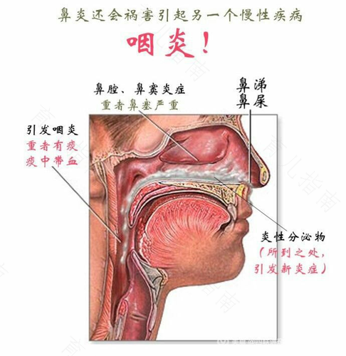 鼻炎会不会引起喉咙不舒服