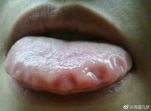 感冒过后舌头痛是怎么回事