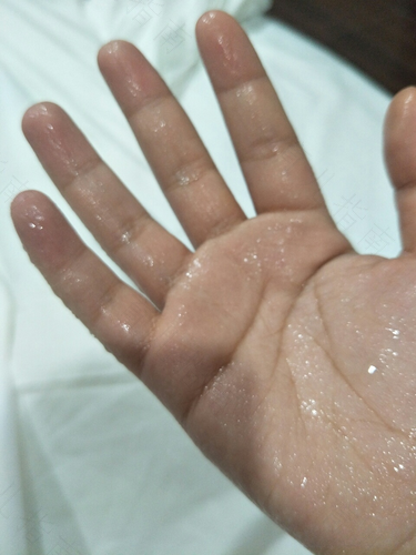 父亲手指畸形会遗传吗 父亲手指畸形会遗传吗