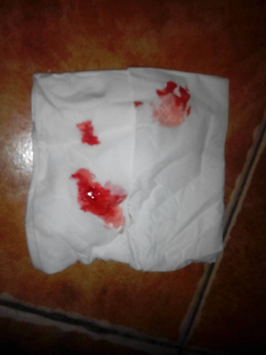 肛门拉屎出血了怎么办 肛门拉屎出血了怎么办