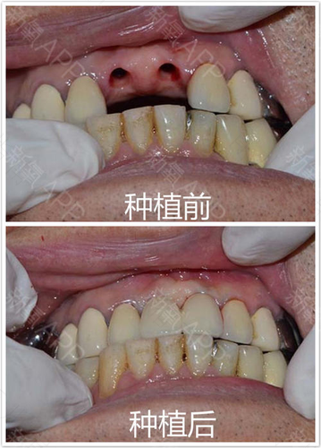 拔完牙多久可以种植牙 拔完牙多久可以种植牙