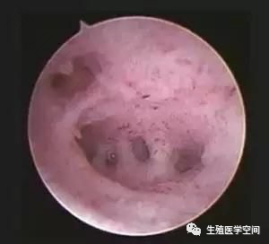 子宫内膜粘连用治疗吗? 子宫内膜粘连用治疗吗?