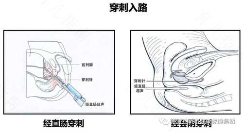 前列腺穿刺后多久痊愈可以性生活