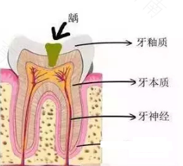 蛀牙痛怎么止痛最快偏方
