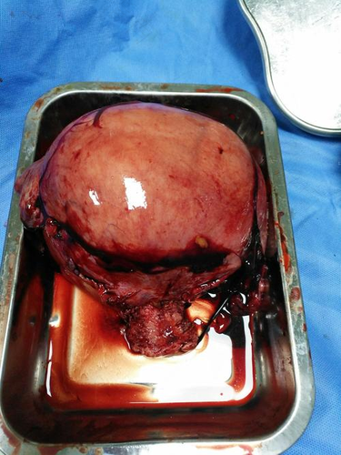 子宫全切除术后多久可以上班 子宫全切除术后多久可以上班