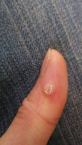 手指头长肉刺怎么办 手指头长肉刺怎么办