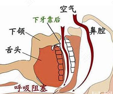 打呼噜是病吗? 打呼噜是病吗?