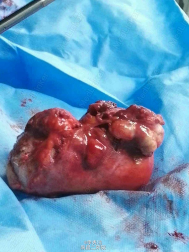 子宫腺肌瘤是良性肿瘤吗 子宫腺肌瘤是良性肿瘤吗