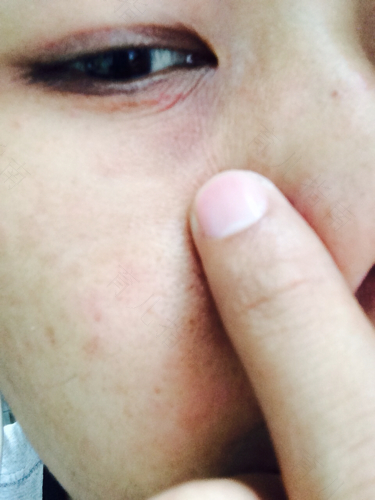 眼睛周围过敏红肿怎么办