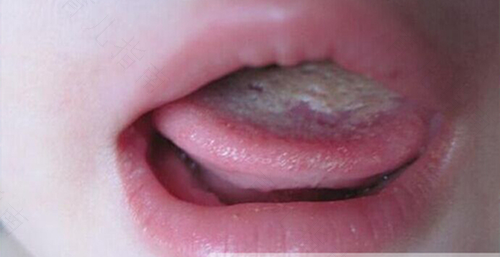 白口疮是怎么引起的吗 白口疮是怎么引起的吗