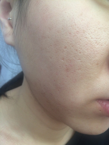 孩子青春痘怎么治疗 孩子青春痘怎么治疗