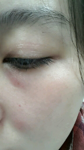 眼部过敏了怎么办最快方法 眼部过敏了怎么办最快方法