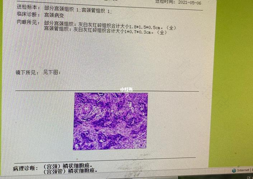 子宫癌早期怎么治疗呢