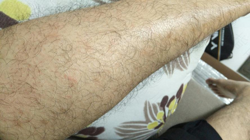 寻麻疹每天反复发作怎么办