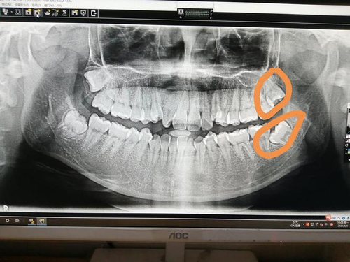 拔牙可以一次拔两颗吗? 拔牙可以一次拔两颗吗?