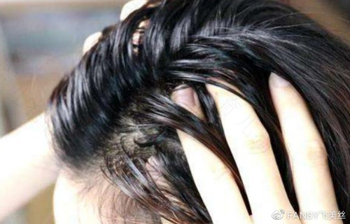 头发总是出油怎么办? 头发总是出油怎么办?