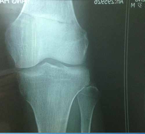17岁骨骺线闭合了怎么办 17岁骨骺线闭合了怎么办
