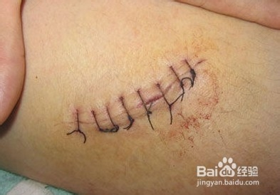 手术缝合伤口裂开了怎么办 手术缝合伤口裂开了怎么办