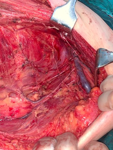 腋窝淋巴结穿刺有什么危害 腋窝淋巴结穿刺有什么危害