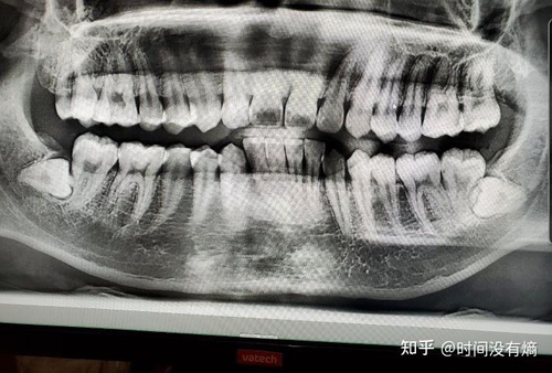 拔智齿前的注意事项有哪些 拔智齿前的注意事项有哪些