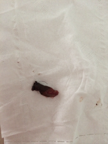 子宫长息肉是怎么引起的 子宫长息肉是怎么引起的