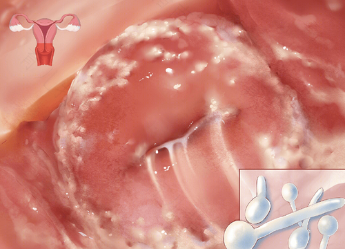 外阴有点肿还有点痒怎么回事 外阴有点肿还有点痒怎么回事