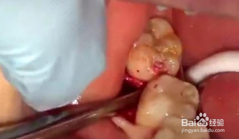 拔下面的智齿有危险吗 拔下面的智齿有危险吗