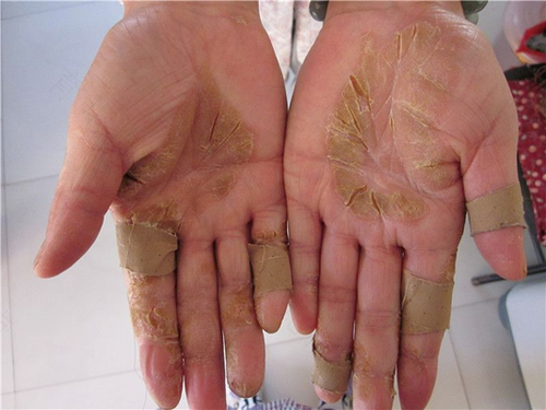 冬天手脚开裂怎么办 冬天手脚开裂怎么办