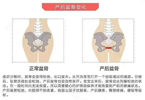 骨盆错位有什么症状 骨盆错位有什么症状