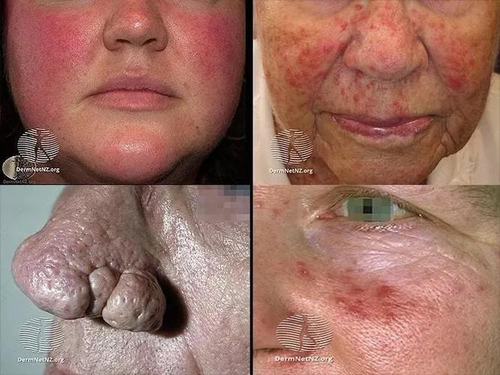 玫瑰痤疮能吃鸡蛋吗 玫瑰痤疮能吃鸡蛋吗