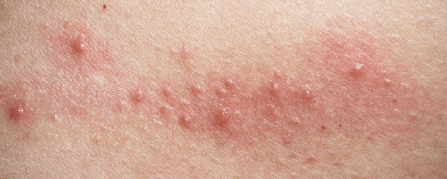 婴儿湿疹会不会自愈