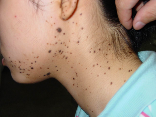 身上有黑点是怎么回事