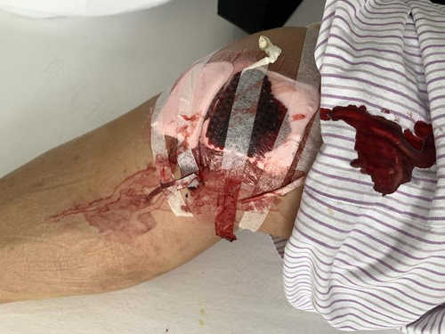 同房撕裂伤口出血了怎么办 同房撕裂伤口出血了怎么办