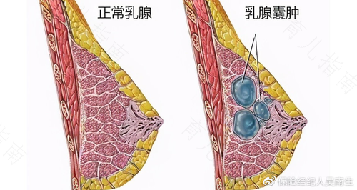乳腺结节4厘米严重吗 乳腺结节4厘米严重吗