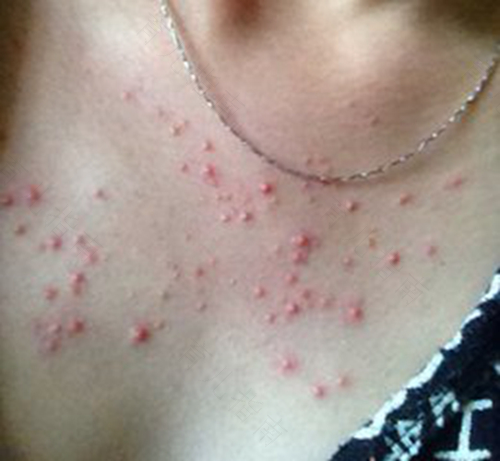 背部毛囊炎是什么引起的原因 背部毛囊炎是什么引起的原因