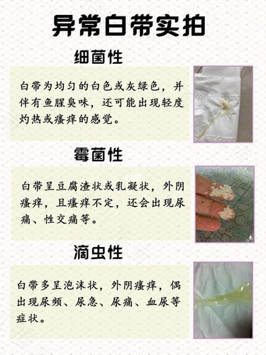 白带发黄有点绿是怎么回事 白带发黄有点绿是怎么回事