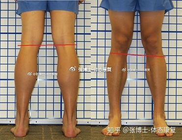 骨折后长短腿怎么锻炼矫正 骨折后长短腿怎么锻炼矫正