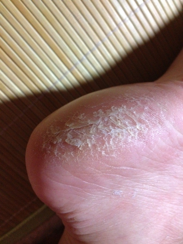 脚底干裂怎么办?
