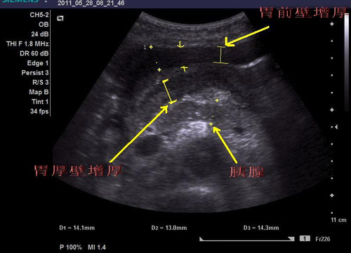 做b超能看出胃有问题吗? 做b超能看出胃有问题吗?