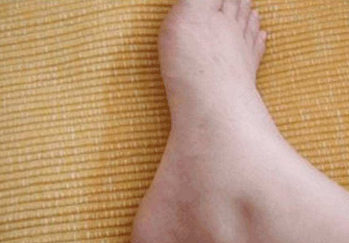 脚肿为什么要抬高腿 脚肿为什么要抬高腿