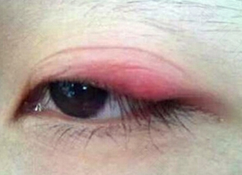 上眼皮起湿疹怎么办